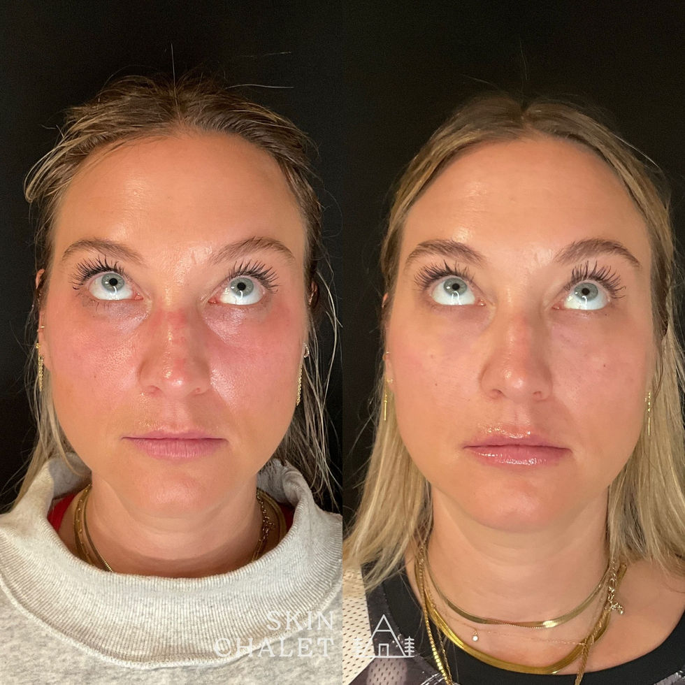 Facial Balancing 6