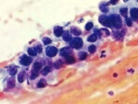 Adenocarcinoma en citologia cervical (Pap-Test)