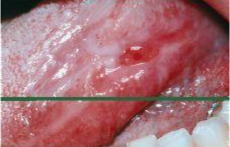 Liquen Plano: La Afección Inflamatoria Crónica