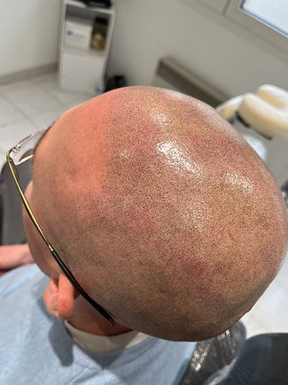 Dermopigmentation capillaire France