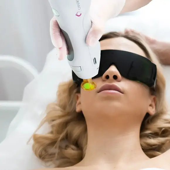 Laser hair removal treatment on the face using Candela technology at Lazuk Esthetics, Alpharetta, GA