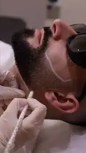 Laser hair removal for your bear and neck in Alpharetta, GA, Lazuk Esthetics