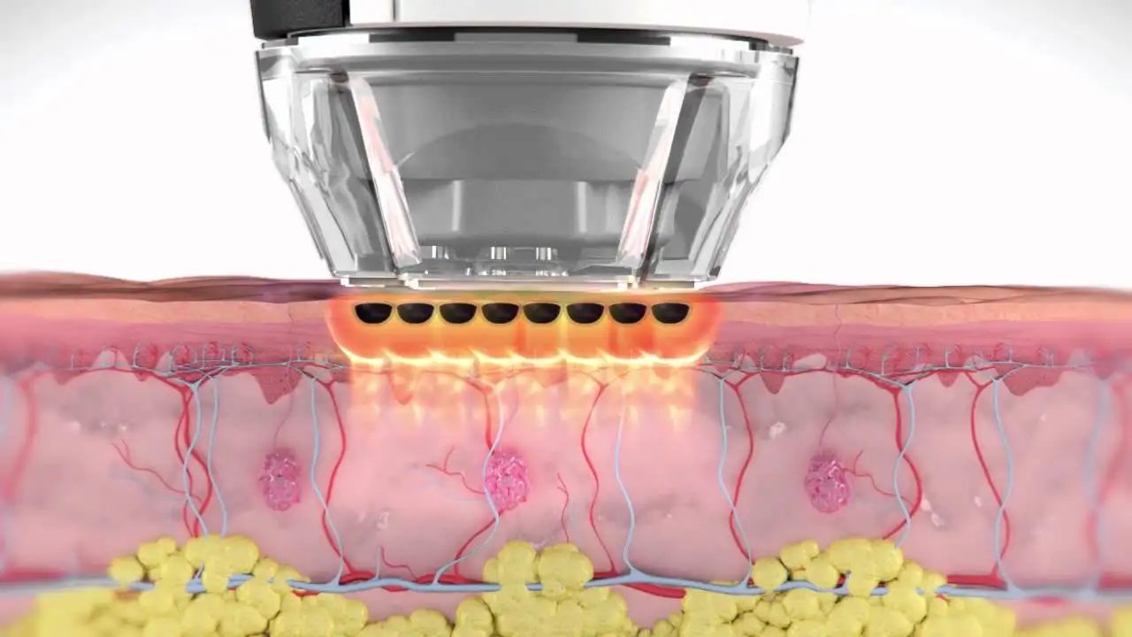 Syneron eMatrix® Skin Rejuvenation in Alpharetta, GA | Lazuk Esthetics