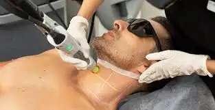 Candela Laser Hair Removal "For Men" in Alpharetta GA | Lazuk Esthetics