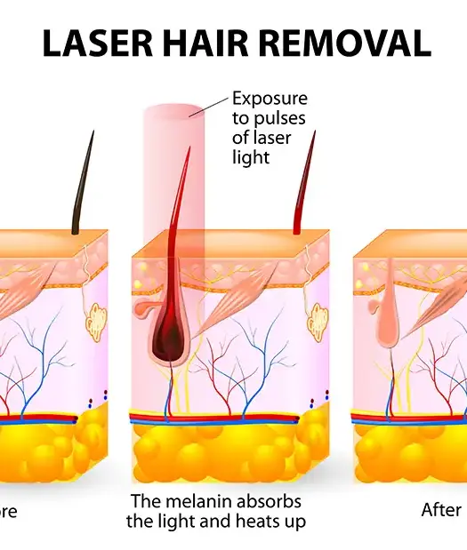 Candela laser hair removal treatment at Dr. Lazuk Esthetics medical spa in Johns Creek, Georgia.