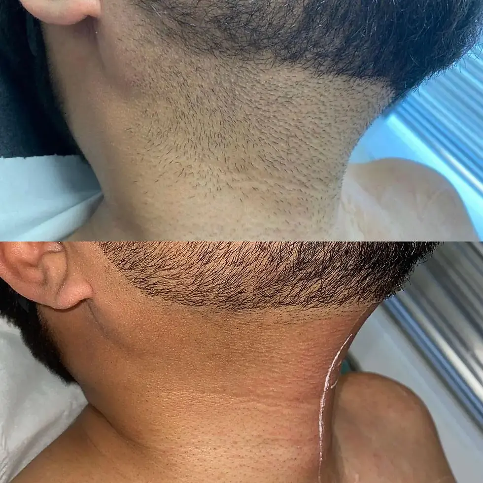 The Hottest Trend in Esthetics for Men, May 2024: Laser Hair Removal by Dr. Lazuk  Innate Esthetics®