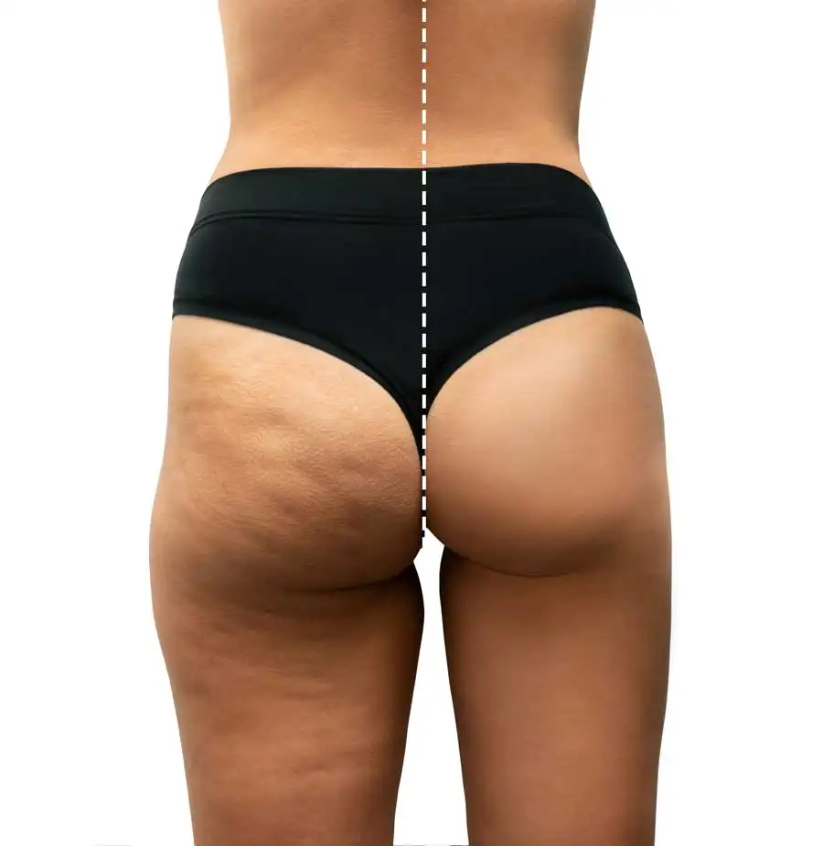 Full-Body Roller Massage Treatment in Alpharetta, GA | Lazuk Esthetics