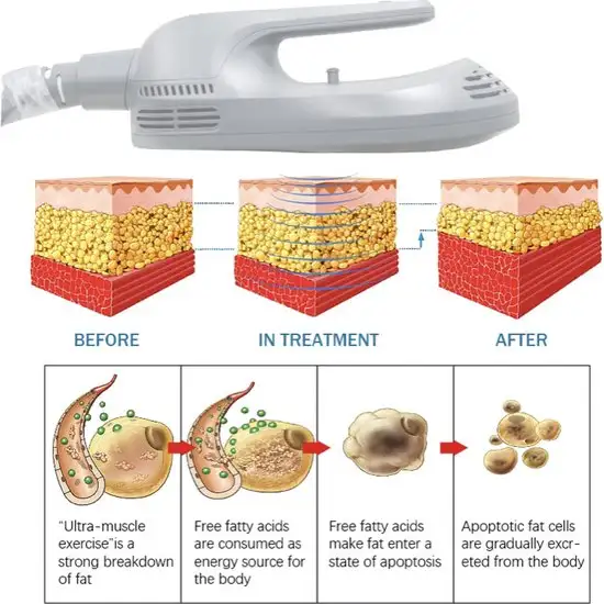 Body Contouring (Nano-Shape) HIEMT+RF | Lazuk Esthetics, Alpharetta, GA