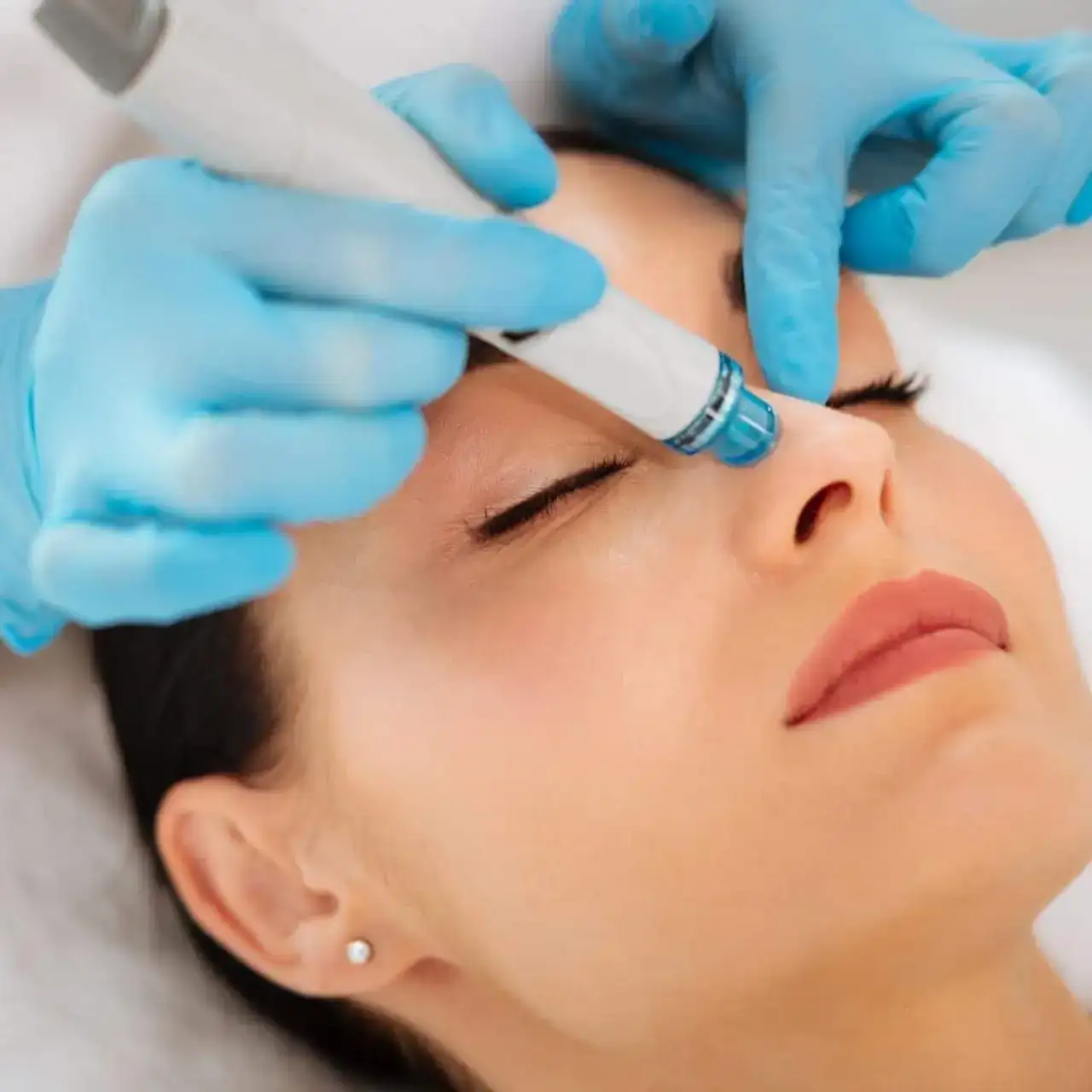 Luxury Hydra-Dermabrasion Facial in Alpharetta, GA | Lazuk Esthetics