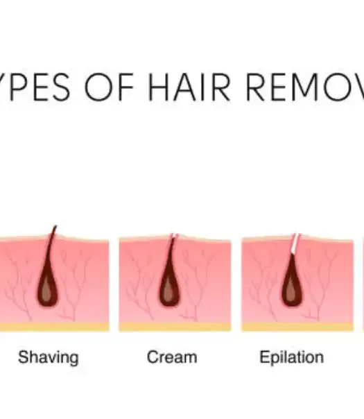 Candela laser hair removal treatment at Dr. Lazuk Esthetics medical spa in Johns Creek, Georgia.