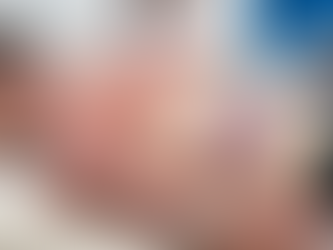 Ventosaterapia para Síndrome Dolorosa Miofascial: Uma Abordagem Descompressiva para Pontos-Gatilho