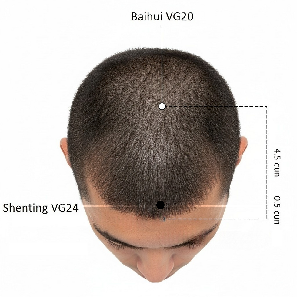 Ilustração anatômica do ponto de acupuntura VG24 Shenting (Pátio do Espírito), na testa, e sua função central em acalmar a mente (Shen) e tratar a ansiedade, a insônia, a dor de cabeça frontal e a sinusite