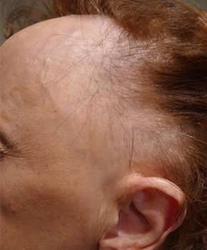 alopecia cicatricial