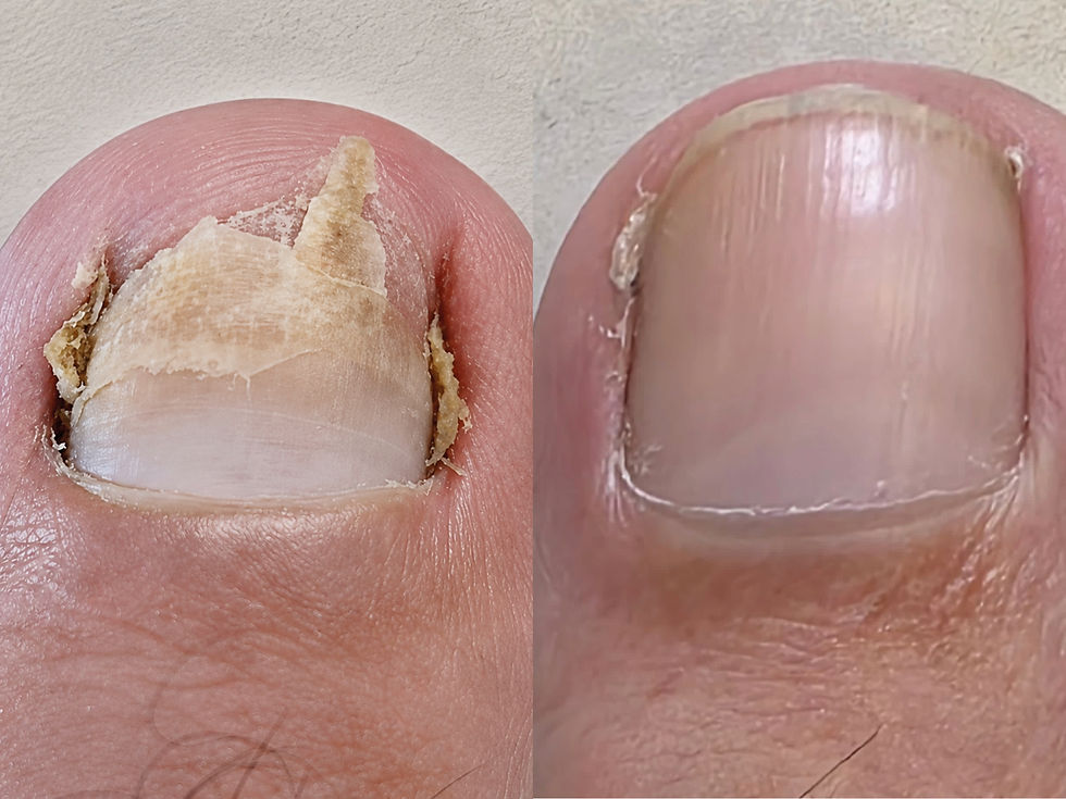 Tratamento para micose das unhas Dra. Carla Pardini