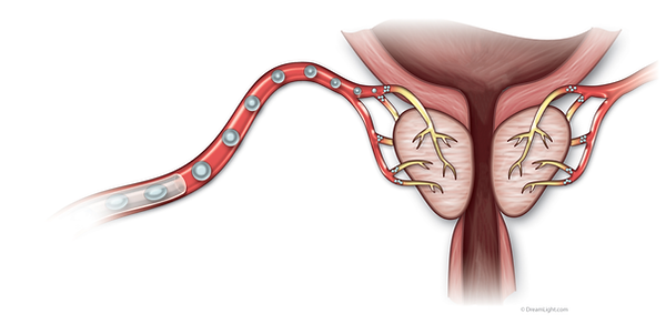 embolisation-prostate.png