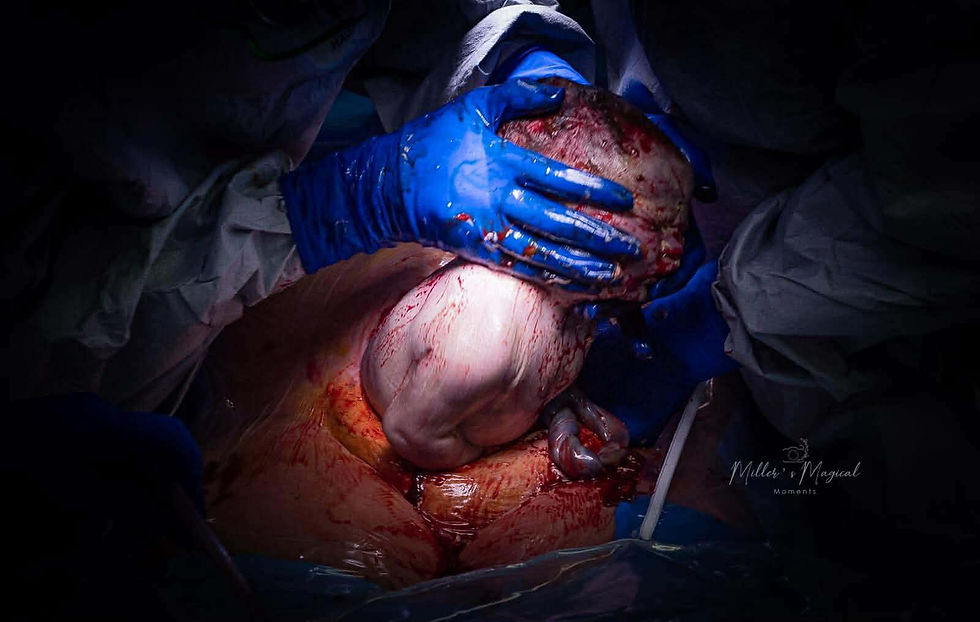 A close up shot of a baby being pulled from the incision sight.