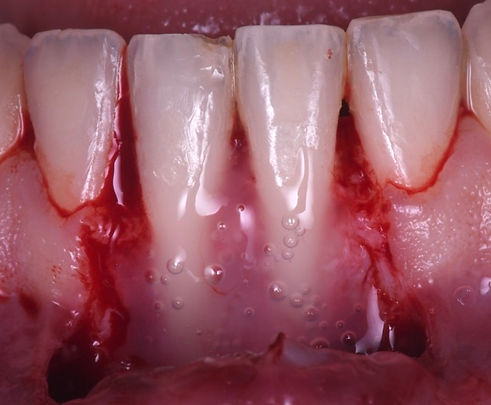 intraorale tessuti molli