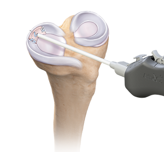 segmental_meniscus_0-xlarge.png