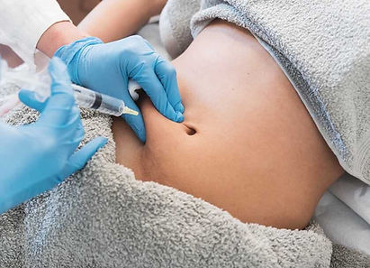 Aqualyx-Fat-Dissolving-Injections-TummyYouthTopia-Skin-Aesthetics-Langdon-Hills-and-Hornch