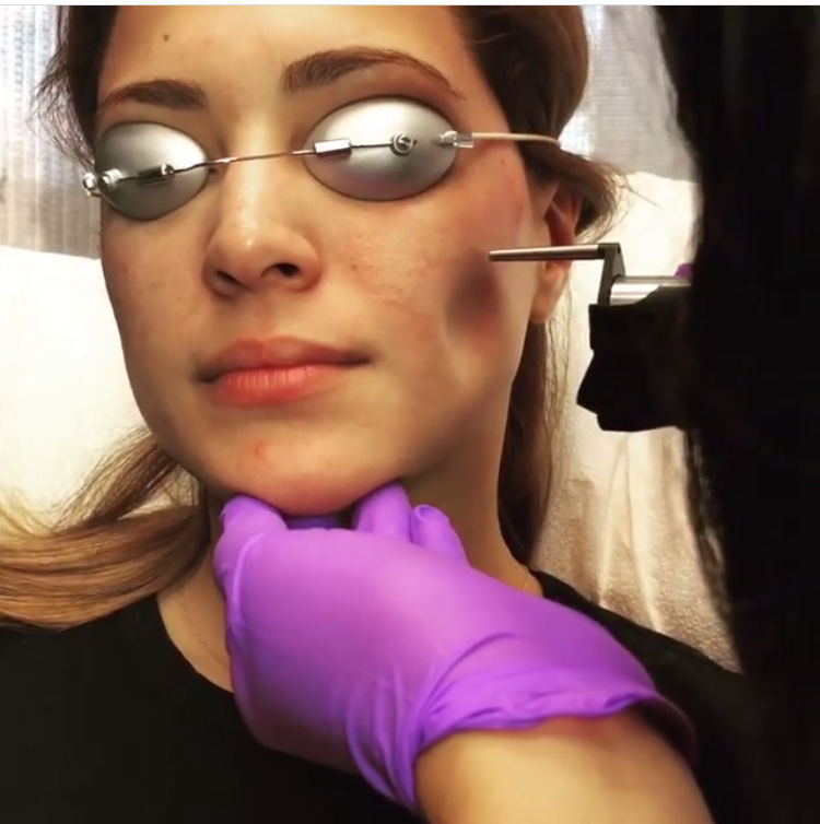 Laser Facials