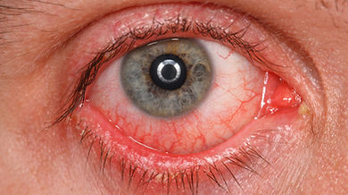 eye health