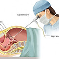 Diagnostic Laparoscopy