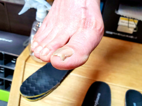 巻き爪なら使うべき!!