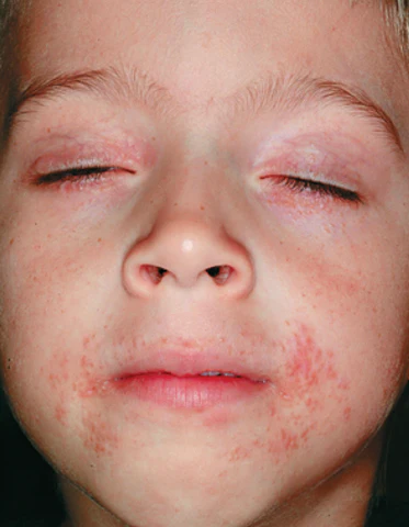 Periorificial Dermatitis kids