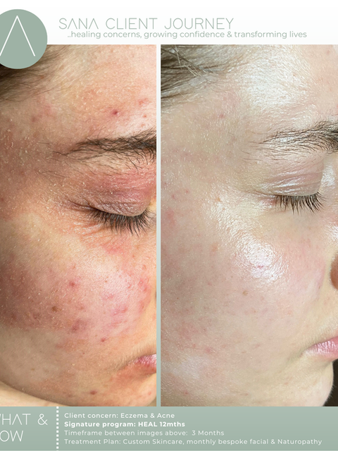 Eczema