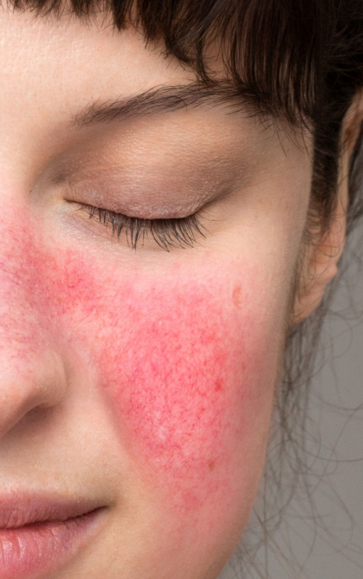 Rosacea & UV