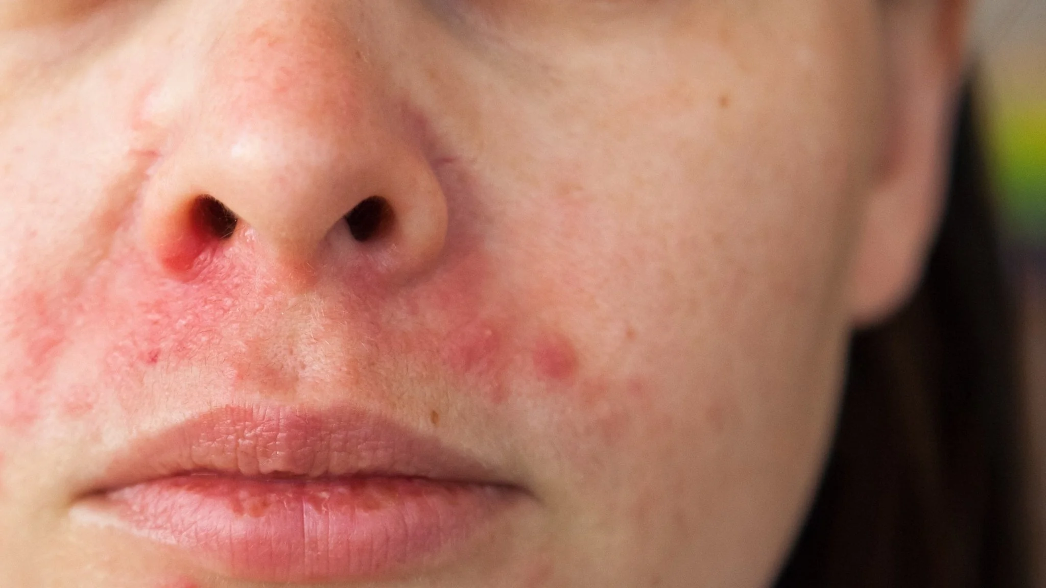 Perioral Dermatitis around nose