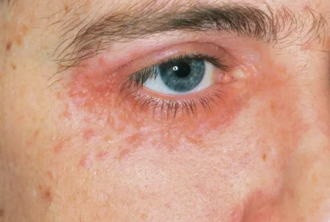 Perioral around eyes