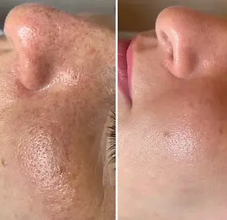 Biorepeel for skin texture