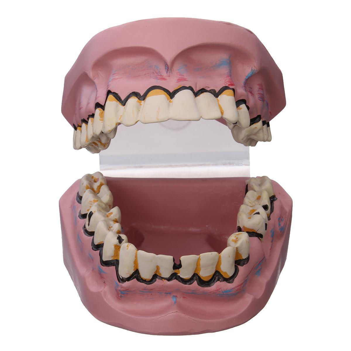 Oral tooth model smoking harm smokers dental caries tooth decay yellow teeth pat