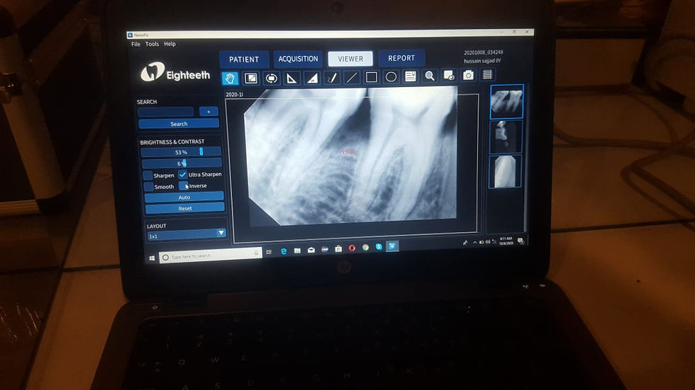 Миниатюра: Nanopix Intraoral X-Ray Sensor (China)