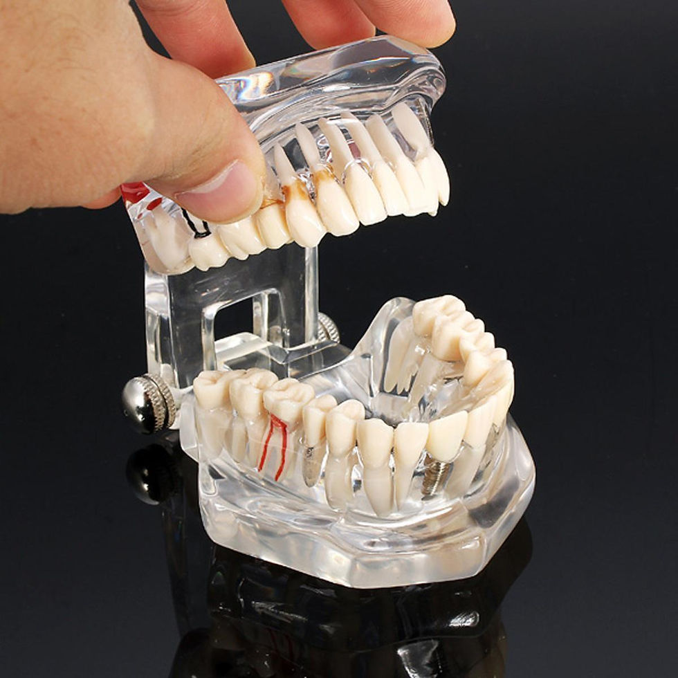 Thumbnail: Implant Disease Restoration Bridge Brackets