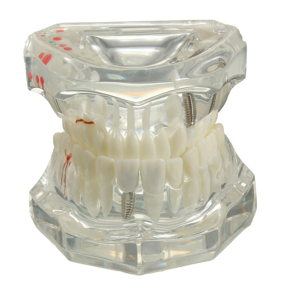 Thumbnail: Implant Disease Restoration Bridge Brackets