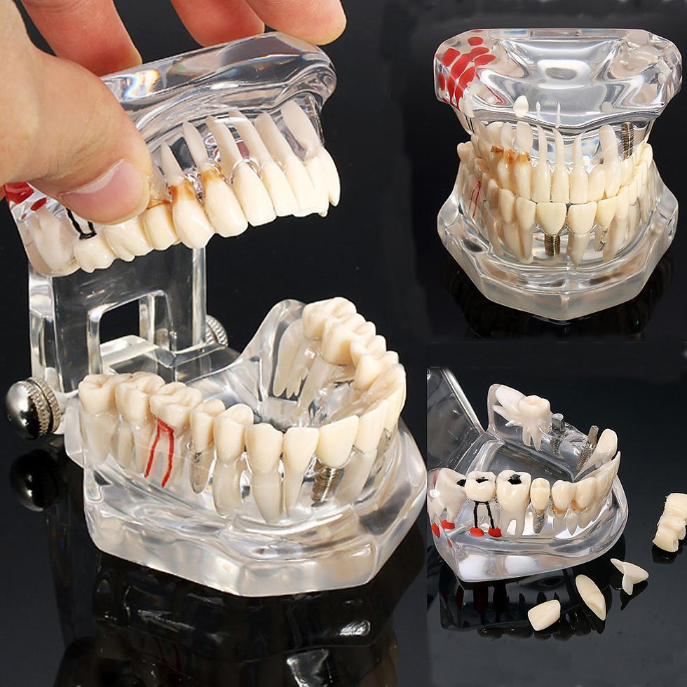 Thumbnail: Implant Disease Restoration Bridge Brackets