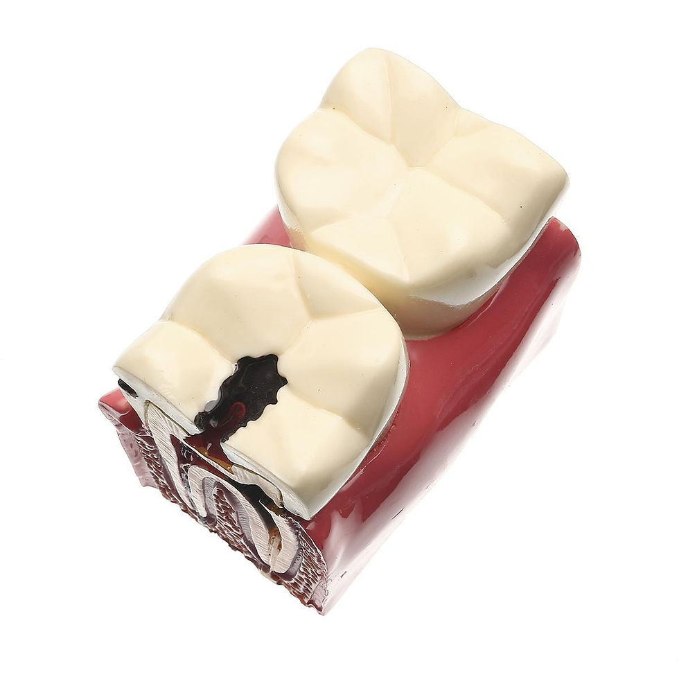 Thumbnail: 6 Times Caries Comparation Study Model
