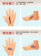 03 手腳各2的急慢性傷口(4張).jpg