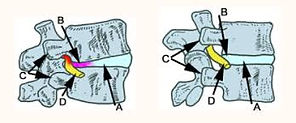 Herniated Disc Diagram