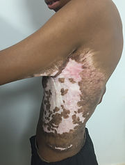 Burn survivor with a burn contracture