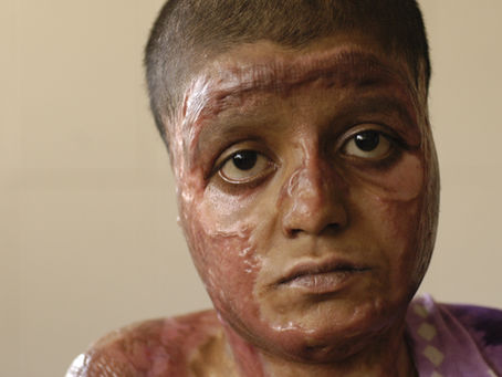 Samir - burns victim