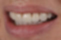 TM smile makeover cropped smile finished tx.JPG