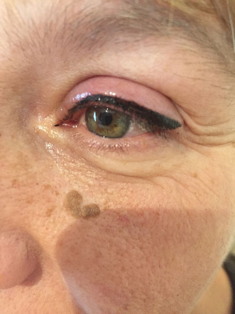 Résultat de maquillage permanent des yeux avec pigmentation de la ligne supérieure.