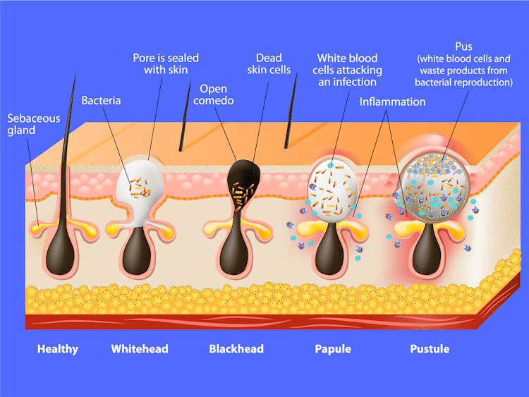 AviClear-SebaceousGland-AestheticSkin-Chicago-Winnetka.gif