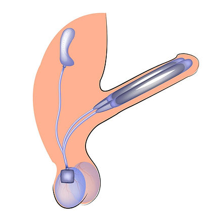 Male_Enhancement_Chicago_Penis_Implant.jpg