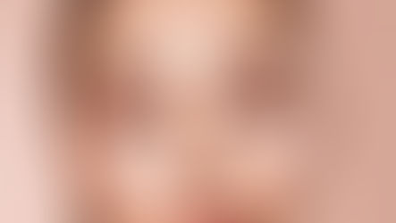 Under Eye Filler Aftercare Tips: A Comprehensive Guide