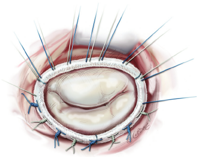 mplanted-annuloplasty-ring-with-the-sutures-partially-knotted.png