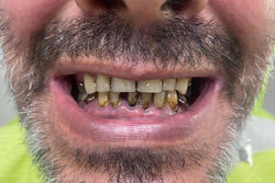 Antes